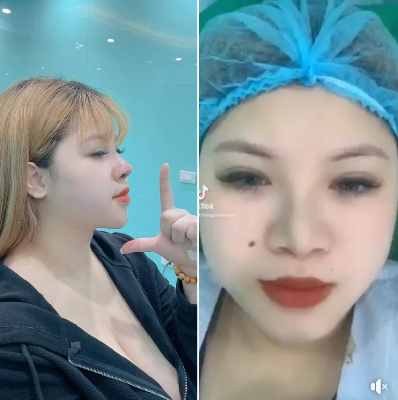 Hotgirl hải dương lận đận sửa sang hút 3 lít mỡ ngực vẫn chưa thon mũi lệch sửa lần 2 - 6