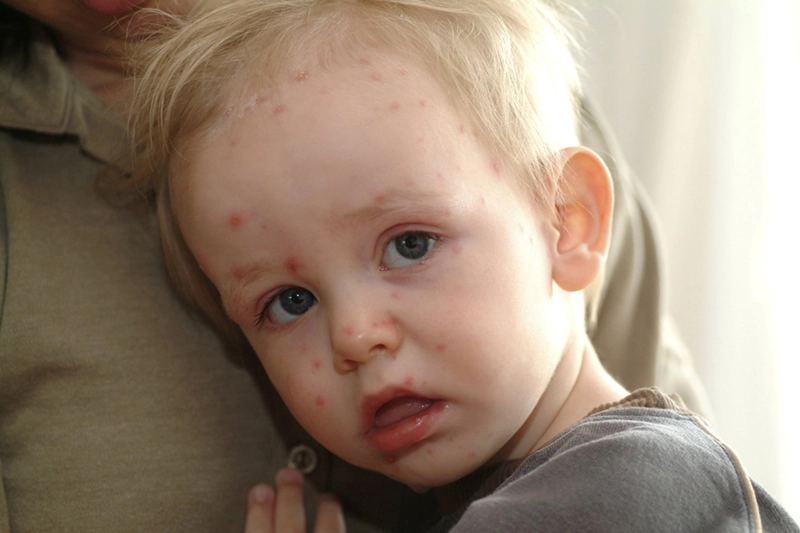 Sốt siêu vi và sốt xuất huyết ở trẻ khác nhau như thế nào - 2