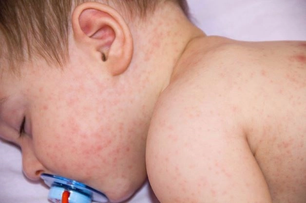 Sốt siêu vi và sốt xuất huyết ở trẻ khác nhau như thế nào - 5