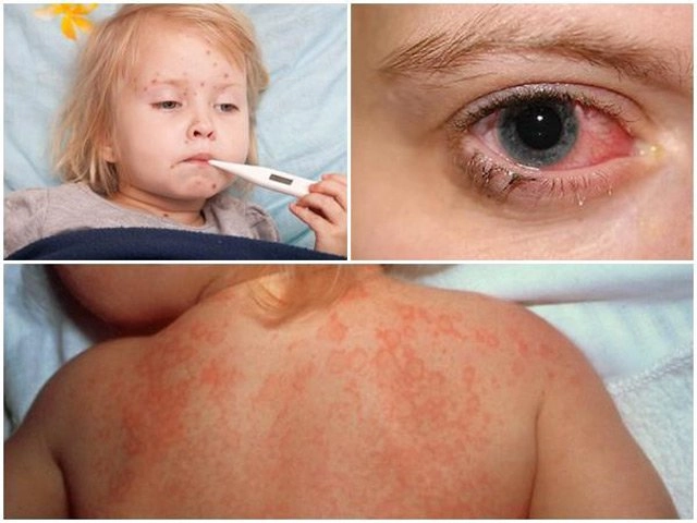 Sốt siêu vi và sốt xuất huyết ở trẻ khác nhau như thế nào - 6