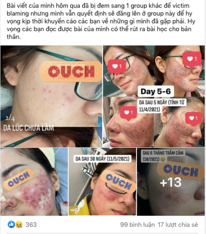 Đi peel da ở spa rởm cô nàng kể chuyện bị cháy đỏ da trầm cảm suốt 6 tháng trời - 1