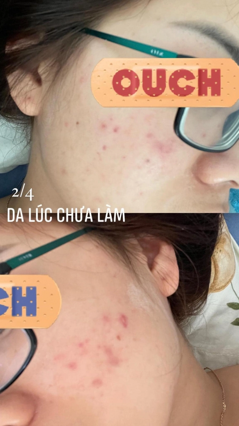 Đi peel da ở spa rởm cô nàng kể chuyện bị cháy đỏ da trầm cảm suốt 6 tháng trời - 2