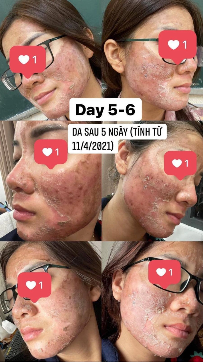 Đi peel da ở spa rởm cô nàng kể chuyện bị cháy đỏ da trầm cảm suốt 6 tháng trời - 3