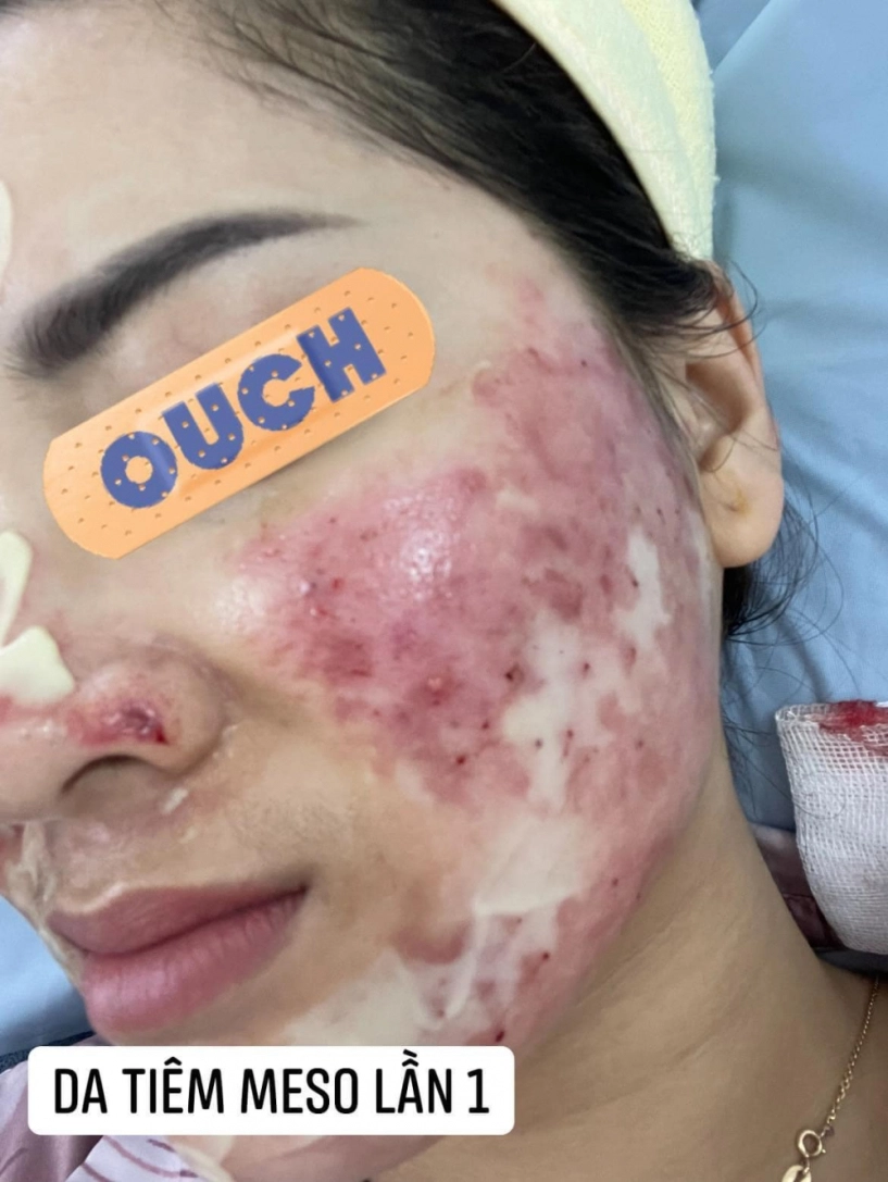 Đi peel da ở spa rởm cô nàng kể chuyện bị cháy đỏ da trầm cảm suốt 6 tháng trời - 4