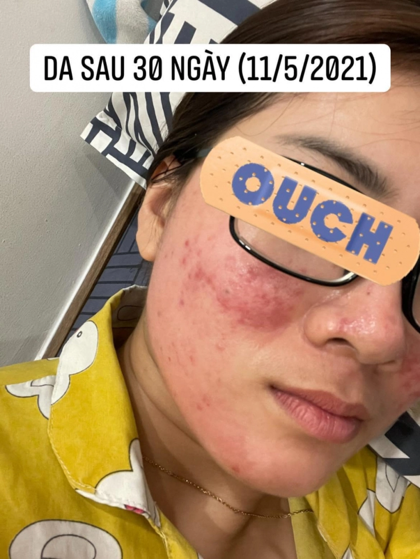 Đi peel da ở spa rởm cô nàng kể chuyện bị cháy đỏ da trầm cảm suốt 6 tháng trời - 5