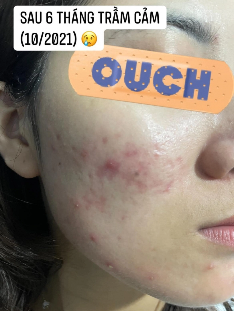 Đi peel da ở spa rởm cô nàng kể chuyện bị cháy đỏ da trầm cảm suốt 6 tháng trời - 6