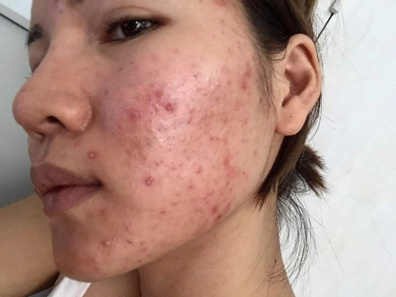 Dùng vitamin c trị thâm da thêm mụn không đều màu là do bạn chưa hiểu rõ serum mình dùng - 1