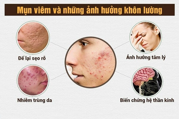 10 cách trị mụn viêm sưng đỏ tại nhà an toàn hiệu quả - 1
