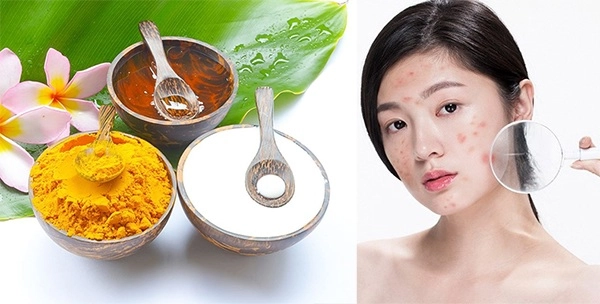 10 cách trị mụn viêm sưng đỏ tại nhà an toàn hiệu quả - 6