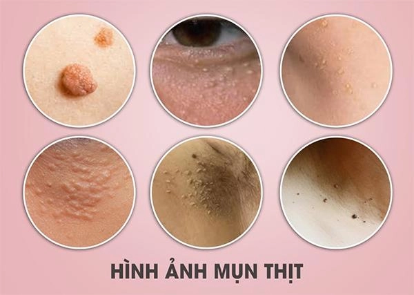 11 cách trị mụn thịt tận gốc tại nhà an toàn hiệu quả nhanh nhất - 1