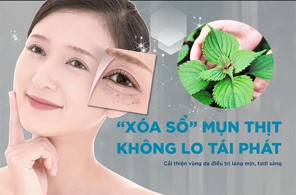 11 cách trị mụn thịt tận gốc tại nhà an toàn hiệu quả nhanh nhất - 5