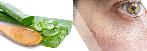 11 cách trị mụn thịt tận gốc tại nhà an toàn hiệu quả nhanh nhất - 7