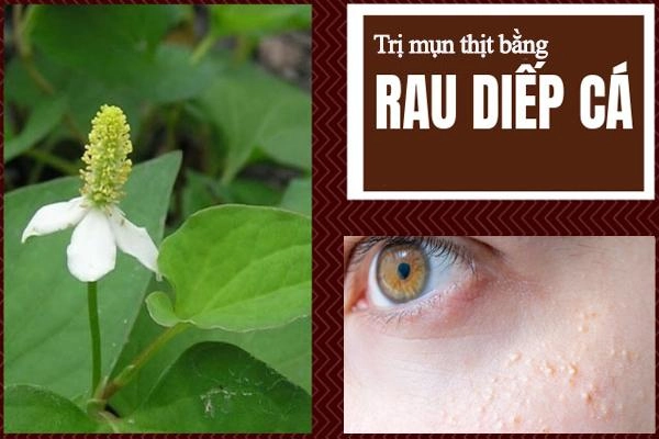 11 cách trị mụn thịt tận gốc tại nhà an toàn hiệu quả nhanh nhất - 13