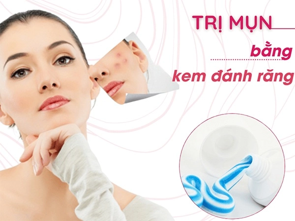 12 cách trị mụn thâm đơn giản an toàn hiệu quả nhanh nhất tại nhà - 2