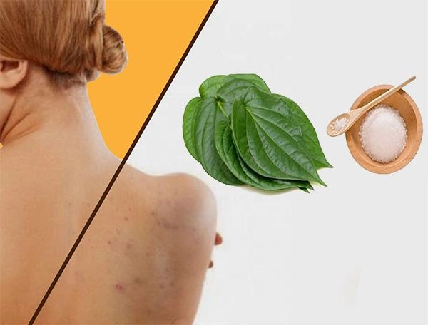 13 cách trị mụn lưng từ nguyên liệu tự nhiên an toàn và hiệu quả nhất - 5