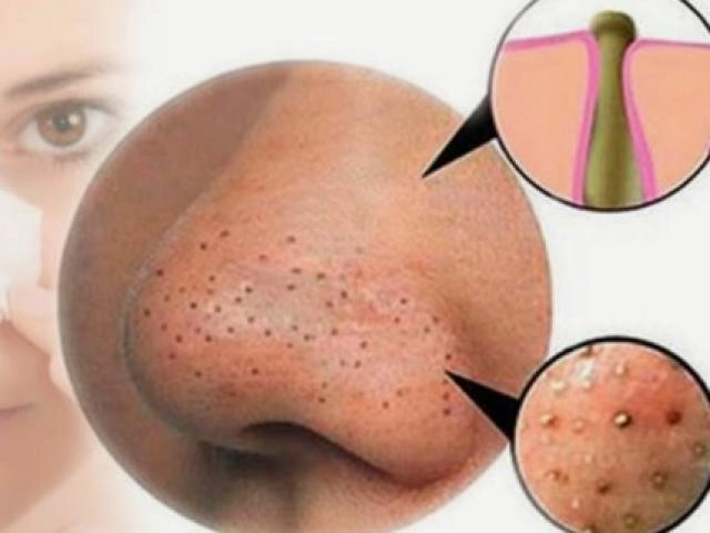 13 cách trị mụn lưng từ nguyên liệu tự nhiên an toàn và hiệu quả nhất - 18