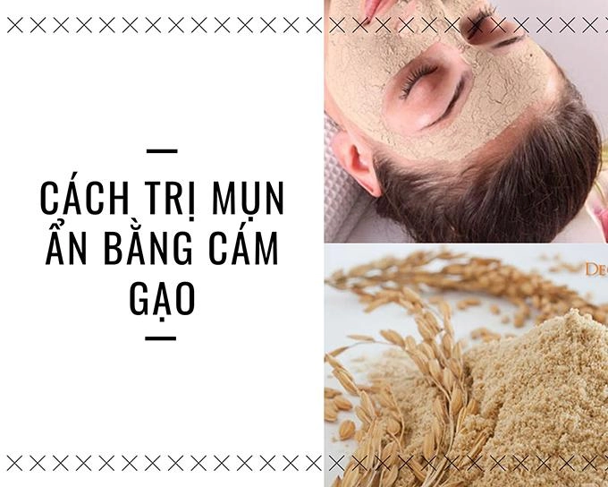 18 cách trị mụn ẩn tại nhà bằng thiên nhiên an toàn hiệu quả nhất - 16