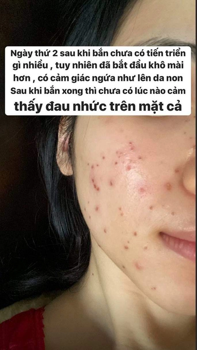 2 người đẹp mặt chi chít tổn thương cắn răng chịu đau vì một làn da láng mịn - 7