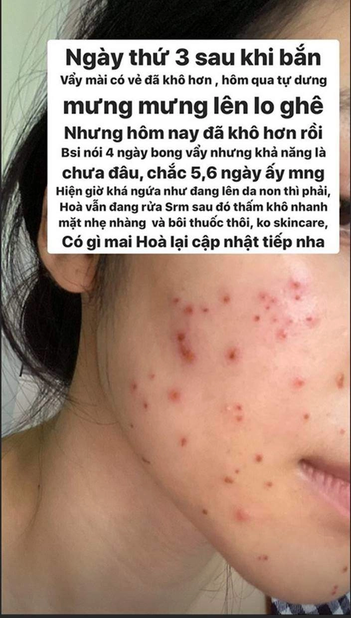 2 người đẹp mặt chi chít tổn thương cắn răng chịu đau vì một làn da láng mịn - 8