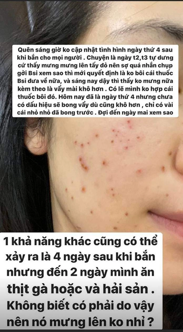 2 người đẹp mặt chi chít tổn thương cắn răng chịu đau vì một làn da láng mịn - 9