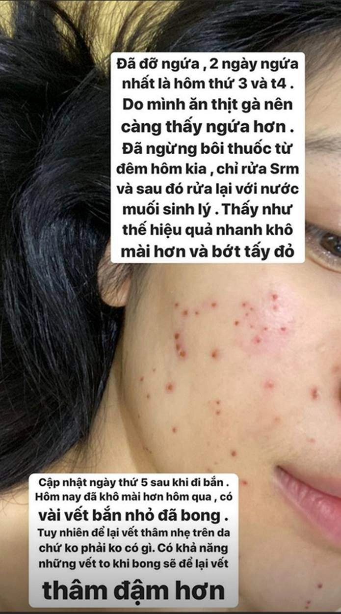 2 người đẹp mặt chi chít tổn thương cắn răng chịu đau vì một làn da láng mịn - 11