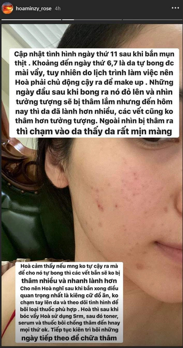 2 người đẹp mặt chi chít tổn thương cắn răng chịu đau vì một làn da láng mịn - 12