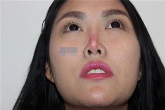 21 lần dao kéo bắt đầu từ tuổi 15 nhan sắc phi thanh vân giờ lên xuống thất thường - 8