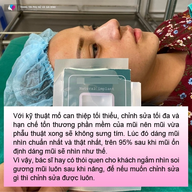 6 câu hỏi thường gặp khi nâng mũi bạn cần biết 95 mũi sau nâng sẽ có dáng chuẩn nhất - 3