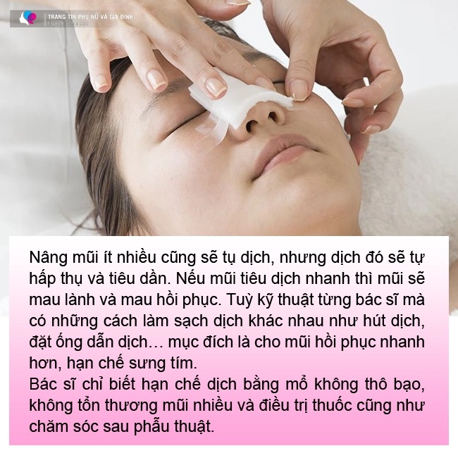 6 câu hỏi thường gặp khi nâng mũi bạn cần biết 95 mũi sau nâng sẽ có dáng chuẩn nhất - 4
