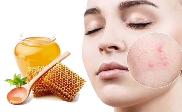 8 cách trị mụn bọc sưng đỏ an toàn hiệu quả không để lại vết thâm - 4