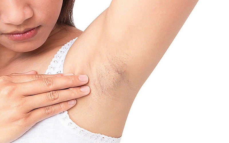 Á hậu phương nga chỉ cách trị thâm nách siêu dễ ai cũng làm được - 11