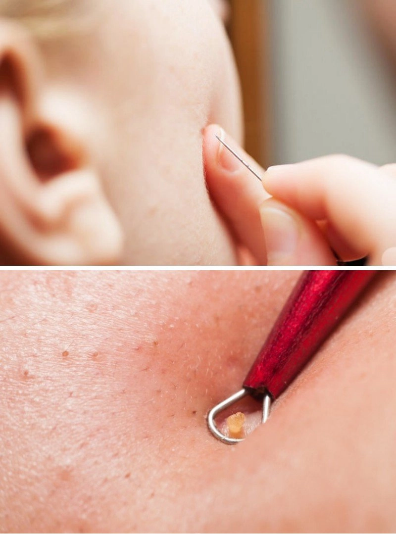 Ái nữ đại gia ngọc thanh tâm tự mua kim nặn mụn làn da nhận cái kết đắng - 9