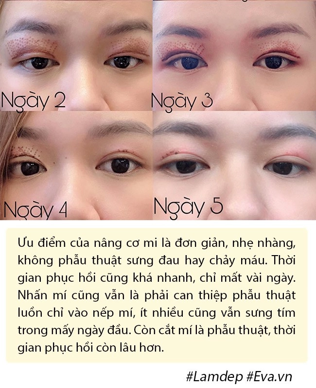 Ảnh xưa và nay đổi khác hiền hồ chối cắt mí nhưng vẫn thừa nhận có làm mí mắt - 12