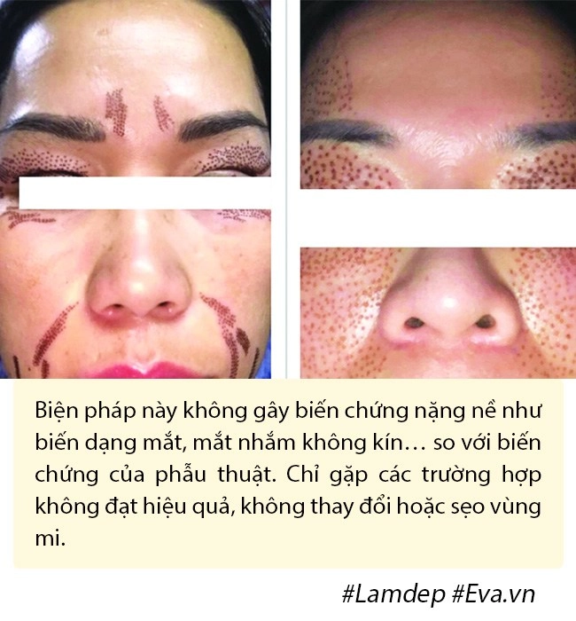 Ảnh xưa và nay đổi khác hiền hồ chối cắt mí nhưng vẫn thừa nhận có làm mí mắt - 14