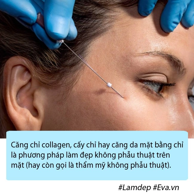 Bạn có đang nhầm lẫn về phương pháp căng chỉ collagen trẻ hóa da mặt - 2