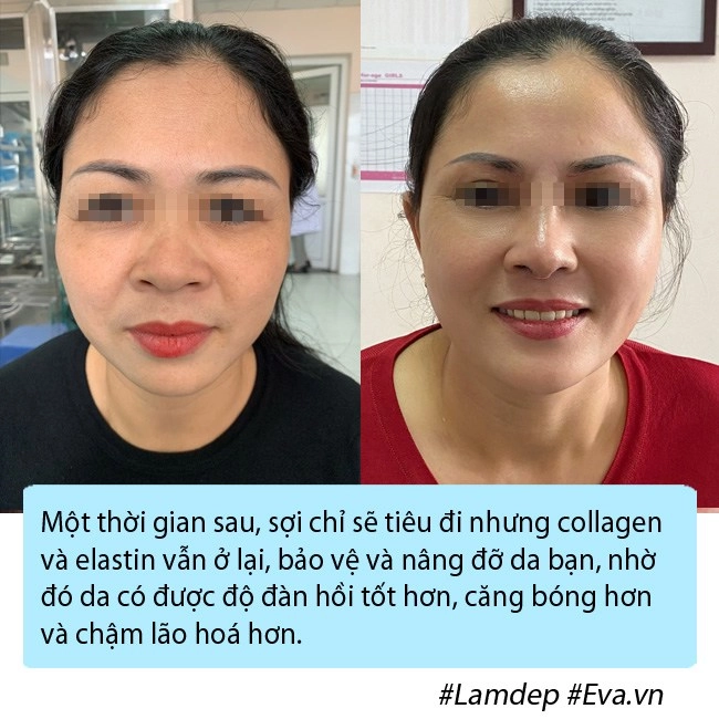 Bạn có đang nhầm lẫn về phương pháp căng chỉ collagen trẻ hóa da mặt - 3