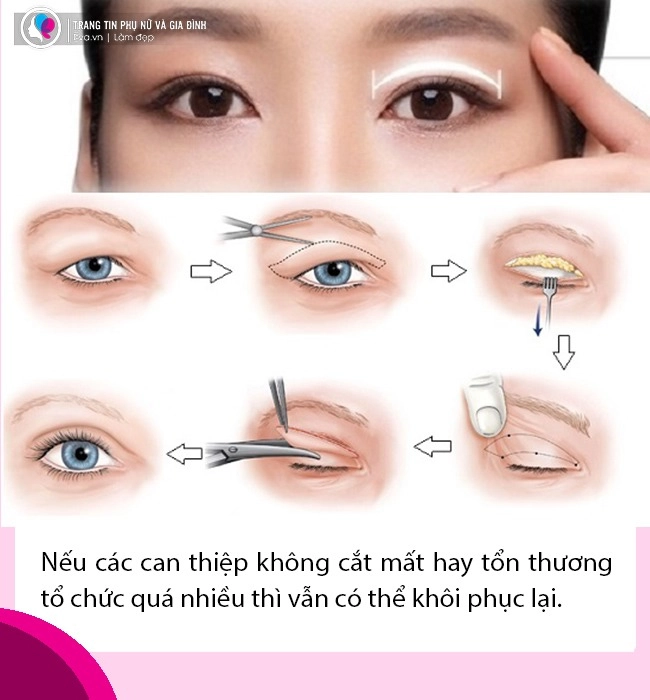 Bất ngờ với tin thúy vi dao kéo lần thứ n nhan sắc làm đi làm lại liệu còn đẹp - 9
