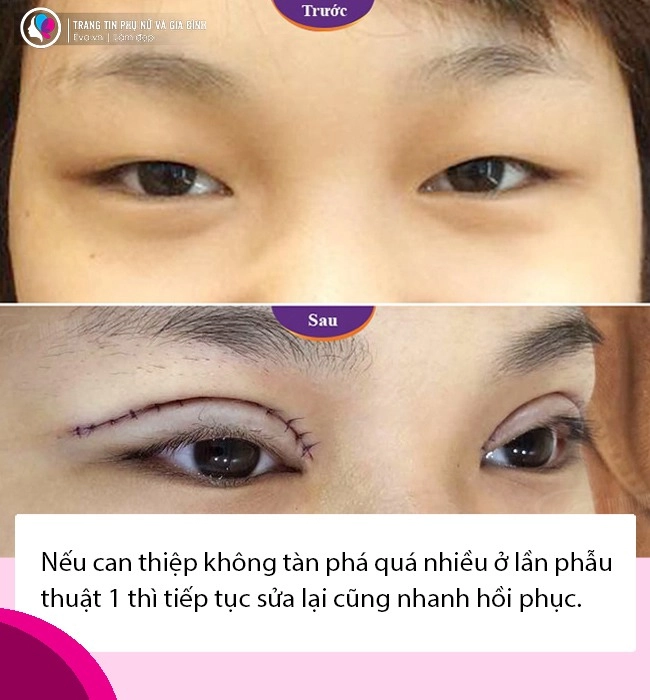 Bất ngờ với tin thúy vi dao kéo lần thứ n nhan sắc làm đi làm lại liệu còn đẹp - 10