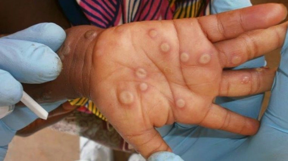 Bệnh đậu mùa khỉ ở trẻ em có nguy hiểm không - 3