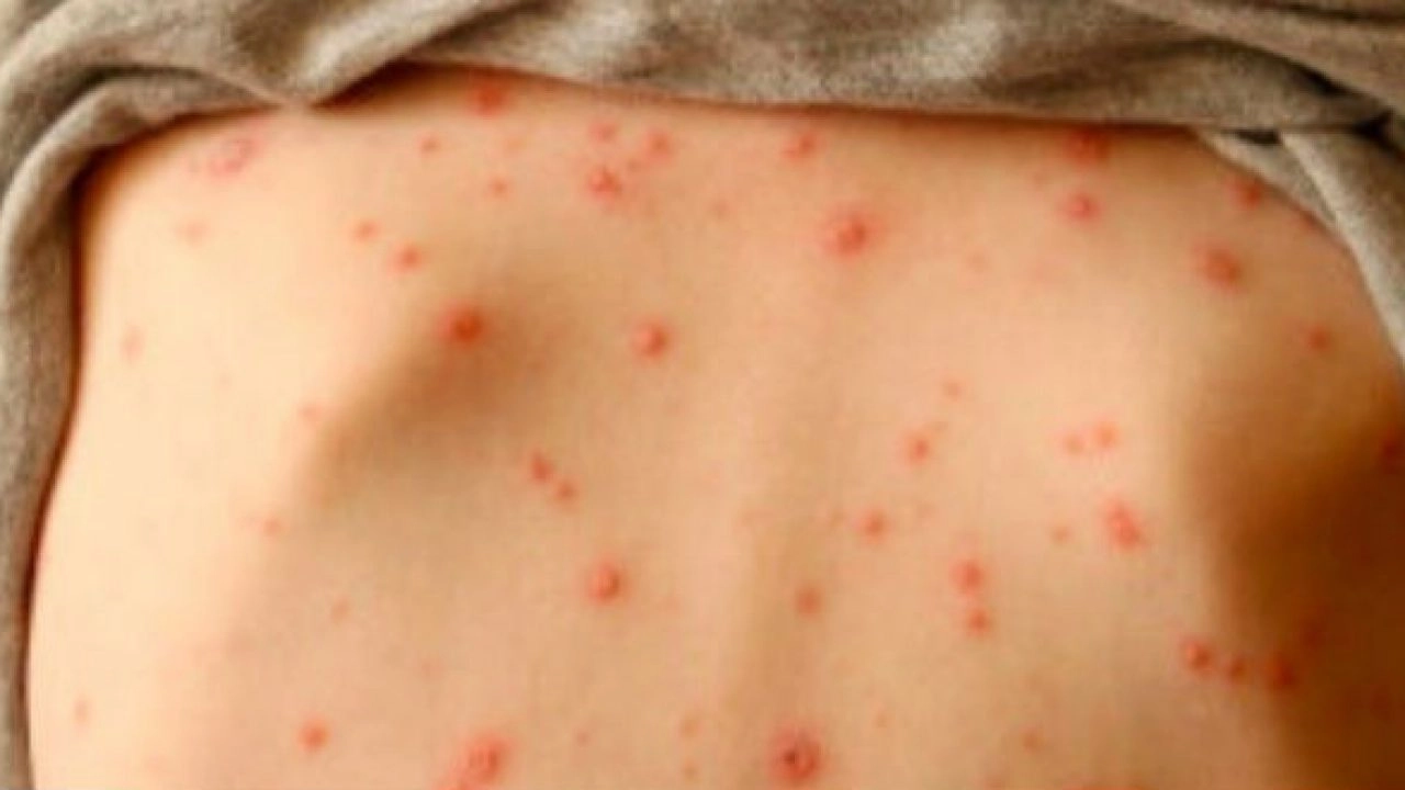 Bệnh thủy đậu ở trẻ em và cách chữa - 3