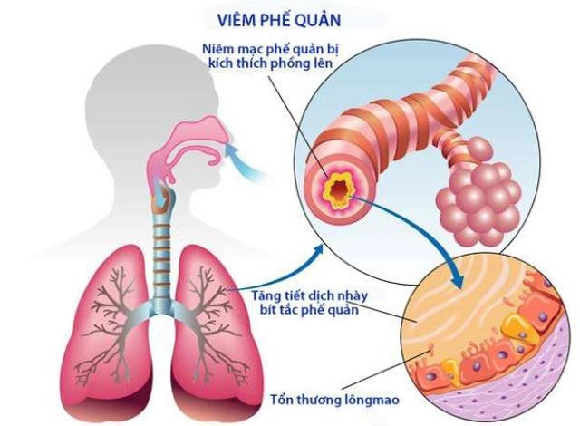 Biến chứng bệnh viêm phế quản ở trẻ em khi không điều trị kịp thời - 2