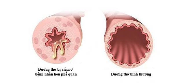 Biến chứng bệnh viêm phế quản ở trẻ em khi không điều trị kịp thời - 3