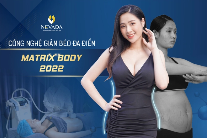Bước đột phá trong ngành thẩm mỹ từ công nghệ giảm béo đa điểm matrix body 2022 - 1