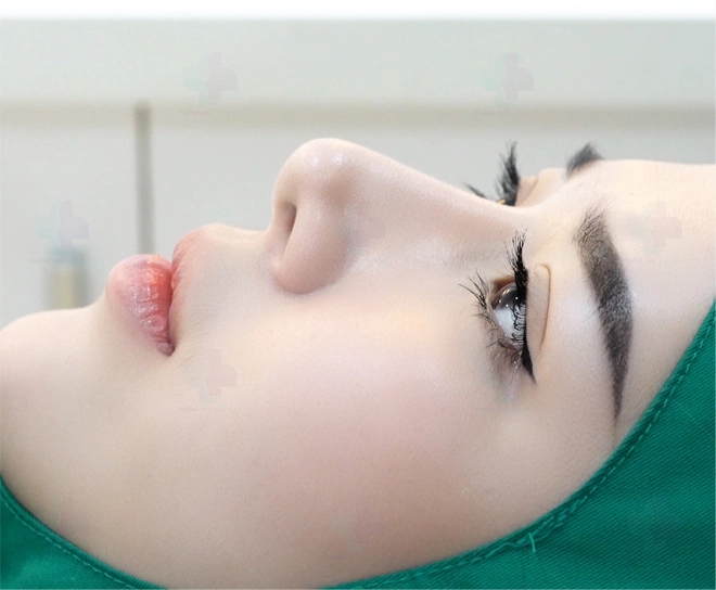 Các phương pháp nâng mũi để đời của bác sĩ lê quý - 2