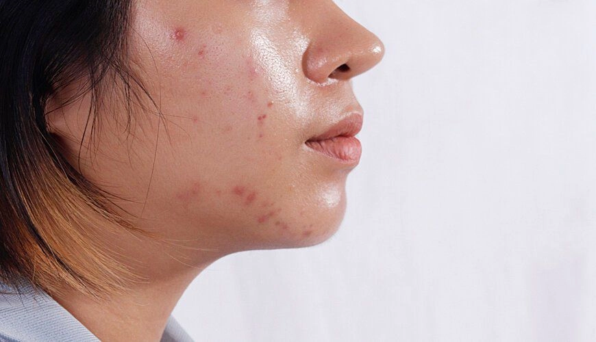 Cách chọn kem chống nắng cho da dầu mụn để cuối ngày da vẫn khô ráo - 1