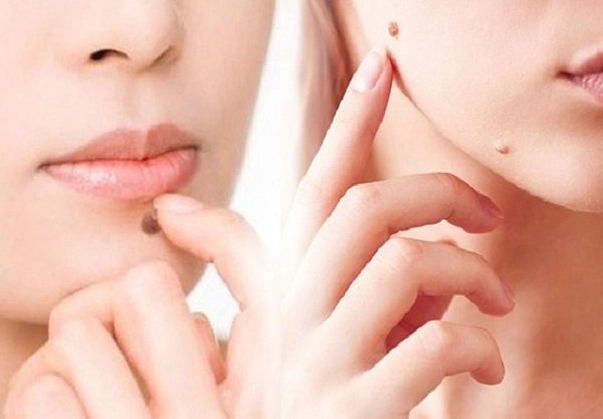 Cách tẩy nốt ruồi an toàn và hướng dẫn chăm sóc sau tẩy tại nhà - 1