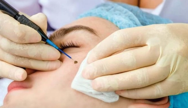 Cách tẩy nốt ruồi an toàn và hướng dẫn chăm sóc sau tẩy tại nhà - 4