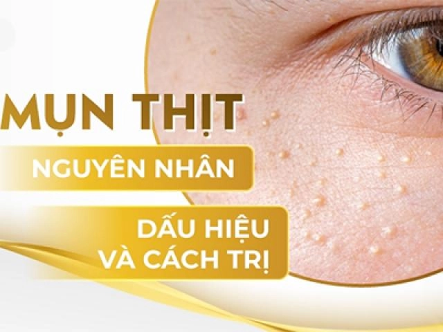 16 cách trị mụn cám tại nhà hiệu quả nhanh nhất từ thiên nhiên - 19