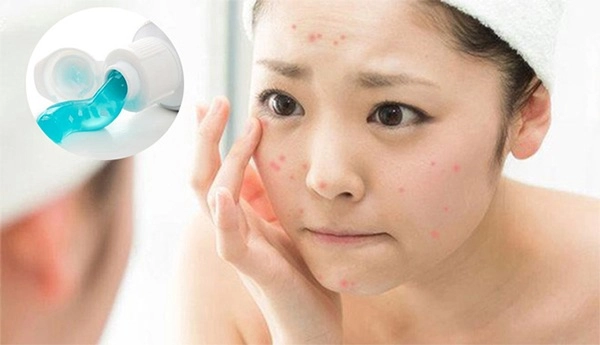 Cách trị mụn bằng kem đánh răng cực an toàn và hiệu quả tại nhà - 3