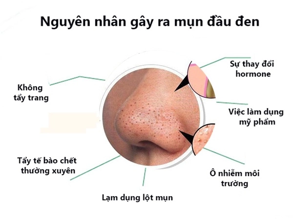 Cách trị mụn đầu đen tại nhà hiệu quả để có làn da trắng sáng mịn màng - 1